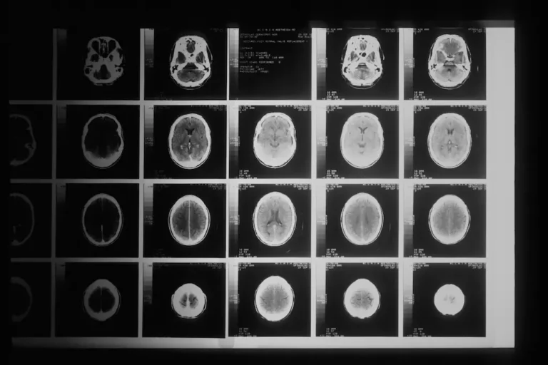 Tomografía computarizada que muestra múltiples imágenes del cráneo, ilustrando la complejidad médica manejada por los abogados de lesiones cerebrales traumáticas de Kevin R. Hansen en Las Vegas.