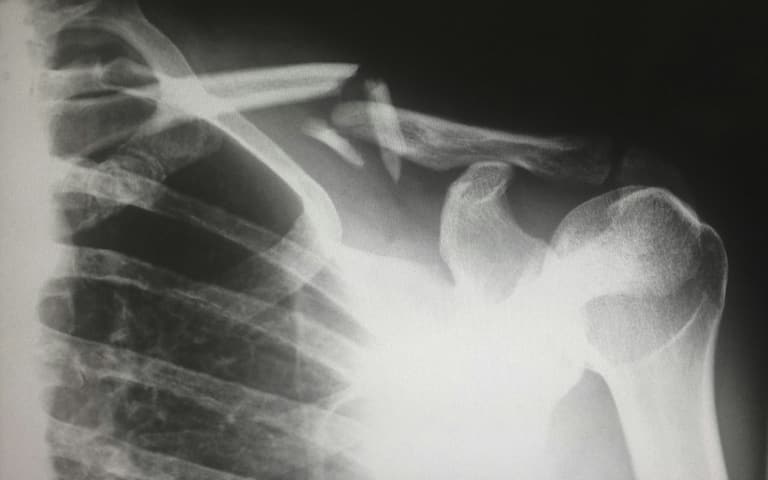 X ray showing broken collar bone. Broken bones are an injury that should be reviewed by a Workers Compensation Attorney in Las Vegas